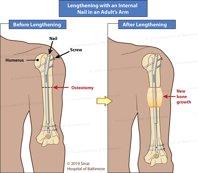 Illustration showing a Precice nail being used to lengthen an adult's humerus (upper arm)