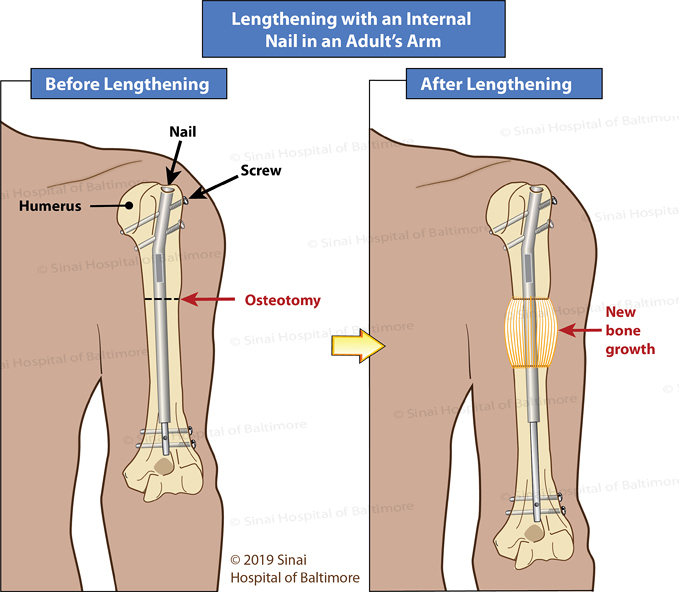 MultiLoc Proximal Humeral Nail