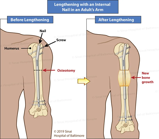 Internal Fixation Rods and Nails  International Center for Limb  Lengthening