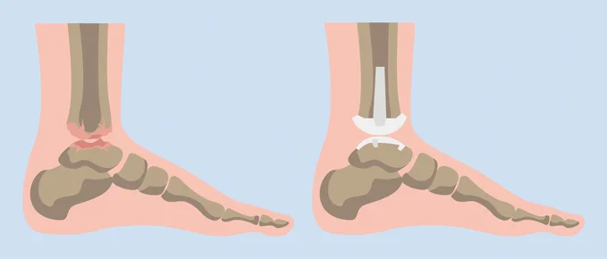 Illustration of a foot from the side showing before and after a total ankle replacement