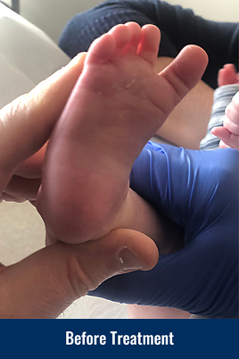 The bottom of a child's foot before being treated for metatarsus adductus