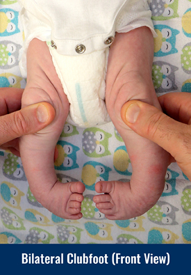 Front view of a baby with bilateral clubfoot