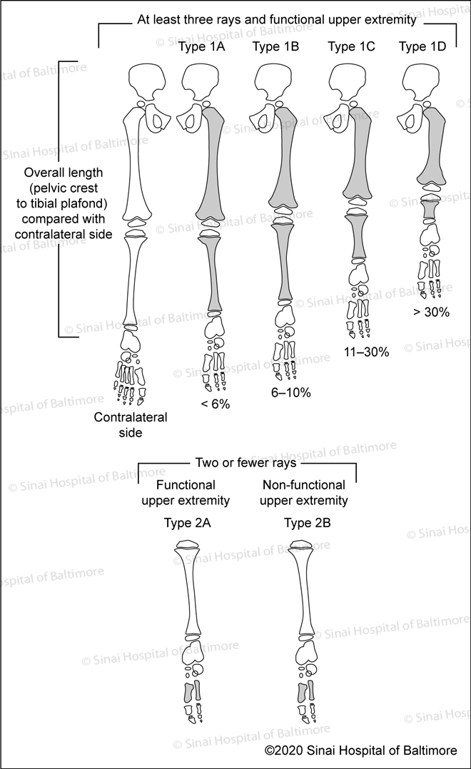 Birch Classification of Fibular Hemimelia: Type IA, Type IB, Type IC, Type ID; Two of fewer rays: Functional upper extremity Type 2A, non-functional upper extremity Type 2B;