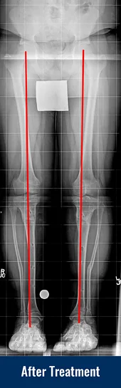 X-ray showing patient’s straight leg after treatment for Blount disease with lines indicating proper limb alignment