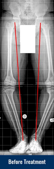 X-ray showing patient’s bowed leg from Blount disease before treatment with lines indicating poor limb alignment