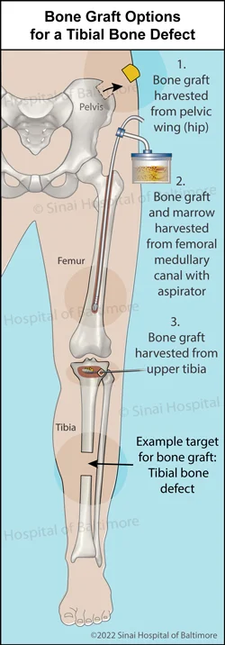 Color illustration showing bone graft options from the pelvic wing, tibia, and femur, for treatment of a tibial bone defect.