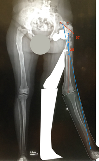 X-ray showing Bone Ninja planning lines for surgery to correct the bone deformity caused by fibrous dysplasia