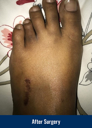 A patient's foot after acute lengthening surgery for brachymetatarsia