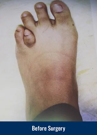 A patient's foot before acute lengthening surgery for brachymetatarsia