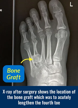 X-ray after surgery for brachymetatarsia showing the location of the bone graft which was to acutely lengthen the fourth toe