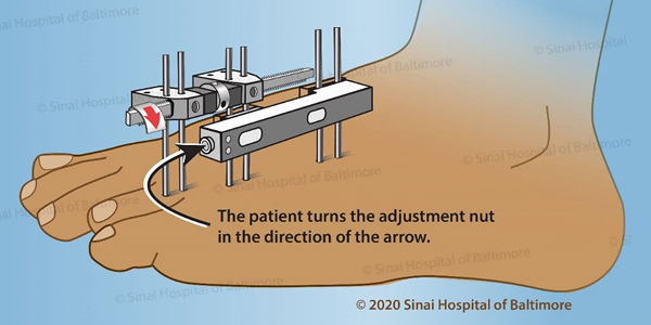 Illustration of a foot with an external fixator applied with instructions for gradual lengthening for treatment of brachymetatarsia