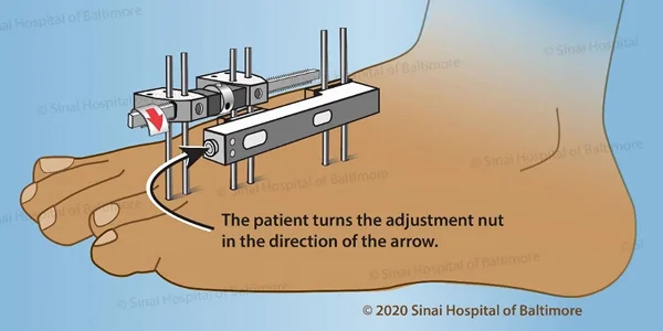 Illustration of a foot with an external fixator applied with instructions for gradual lengthening for treatment of brachymetatarsia