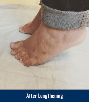 A patient's feet after gradual lengthening for brachymetatarsia