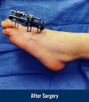 A patient's foot with an external fixator applied after surgery for brachymetatarsia