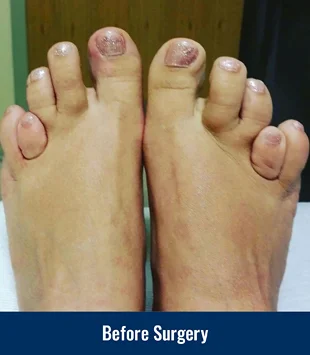 A patient's feet with bilateral brachymetatarsia before surgery