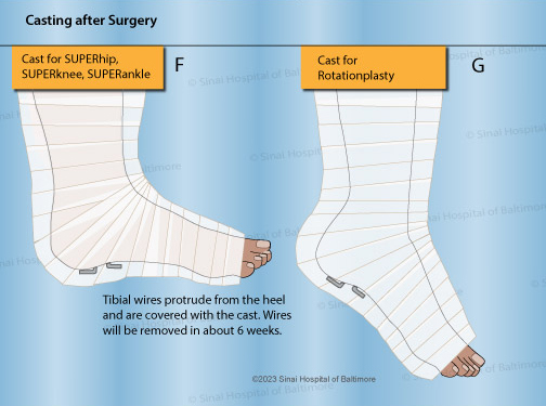Illustration showing casting for an ankle after SUPERankle surgery
