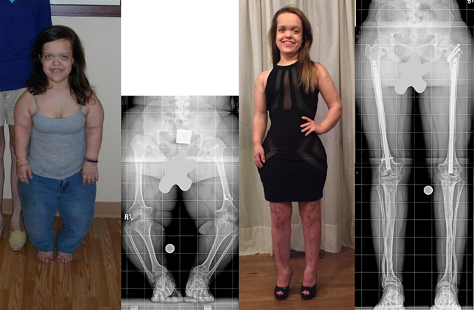 A set of four images: two photos and two X-rays of a female patient with achondroplasia. One picture is labeled 2010 and that picture and the first X-ray from her waist down show her before treatment. A second picture labeled 2015 depicts Chandler after completing treatment where she is significantly taller; the accompanying X-ray from the waist down post-treatment shows her dramatically longer and straighter legs.