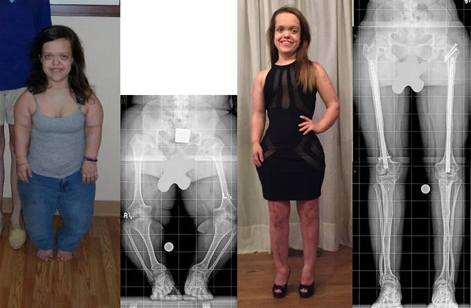 A set of four images: two photos and two X-rays of a female patient with achondroplasia. One picture is labeled 2010 and that picture and the first X-ray from her waist down show her before treatment. A second picture labeled 2015 depicts Chandler after completing treatment where she is significantly taller; the accompanying X-ray from the waist down post-treatment shows her dramatically longer and straighter legs.