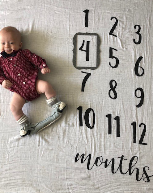 A baby with clubfoot smiling on a blanket in the boots and bar stage of the Ponseti Method