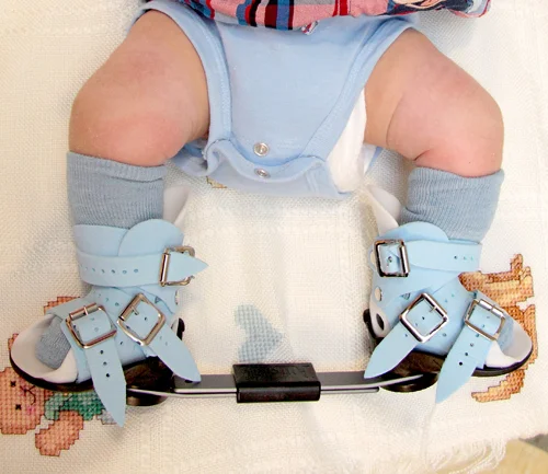 A baby with clubfoot in the boots and bar stage of the Ponseti Method