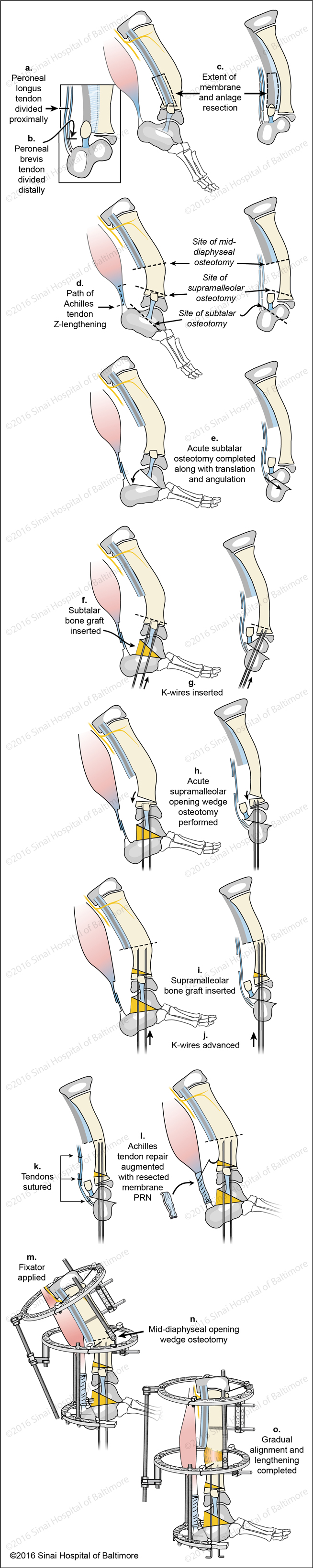 SUPERankle Surgical Technique for Combined Subtalar and Supramalleolar Fibular Hemimelia (Paley Type 3C) Fig. A, Peroneal longus tendon is divided proximally. B, Peroneal brevis tendon is divided distally. C, The extent of the membrane and anlage resection is identified. D, The path of the Achilles tendon Z-lengthening is identified along with the sites of the mid-diaphyseal, supramalleolar, and subtalar osteotomies. E, Acute subtalar osteotomy completed along with translation and angulation. F, Subtalar bone graft is inserted. G, K-wires are inserted. H, Acute supramalleolar wedge osteotomy is performed. I, Supramalleolar bone graft is inserted. J, K-wires are advanced. K, Tendons are sutured. L, The Achilles tendon repair is augmented with the resected membrane as needed. M, The fixator is applied. N, The location of the mid-diaphyseal opening wedge osteotomy is identified. O, Gradual alignment and lengthening is completed.