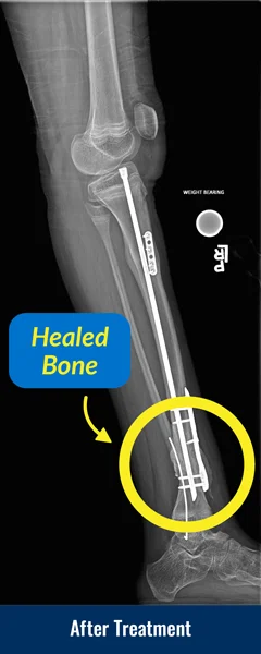 X-ray of a tibia after treatment using a SLIM nail for congenital pseudarthrosis of the tibia