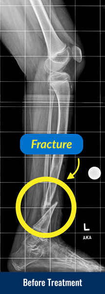 X-ray of a tibia before treatment for congenital pseudarthrosis of the tibia