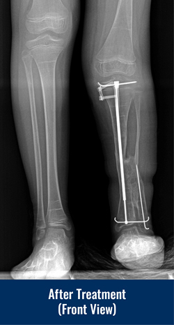 Front view X-ray of a patient's legs after treatment with a Fassier-Duval rod for congenital pseudarthrosis of the tibia