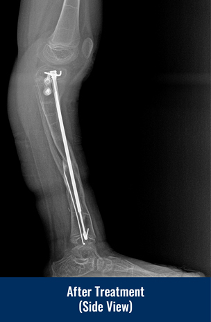 Side view X-ray of a patient's leg after treatment with a Fassier-Duval rod for congenital pseudarthrosis of the tibia