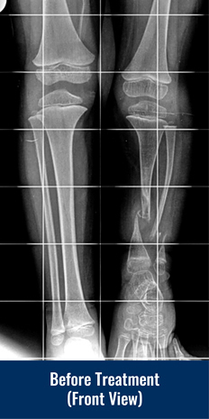 Front view X-ray of a patient's legs before treatment for congenital pseudarthrosis of the tibia