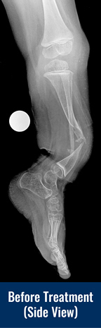 Side view X-ray of a patient's leg before treatment for congenital pseudarthrosis of the tibia