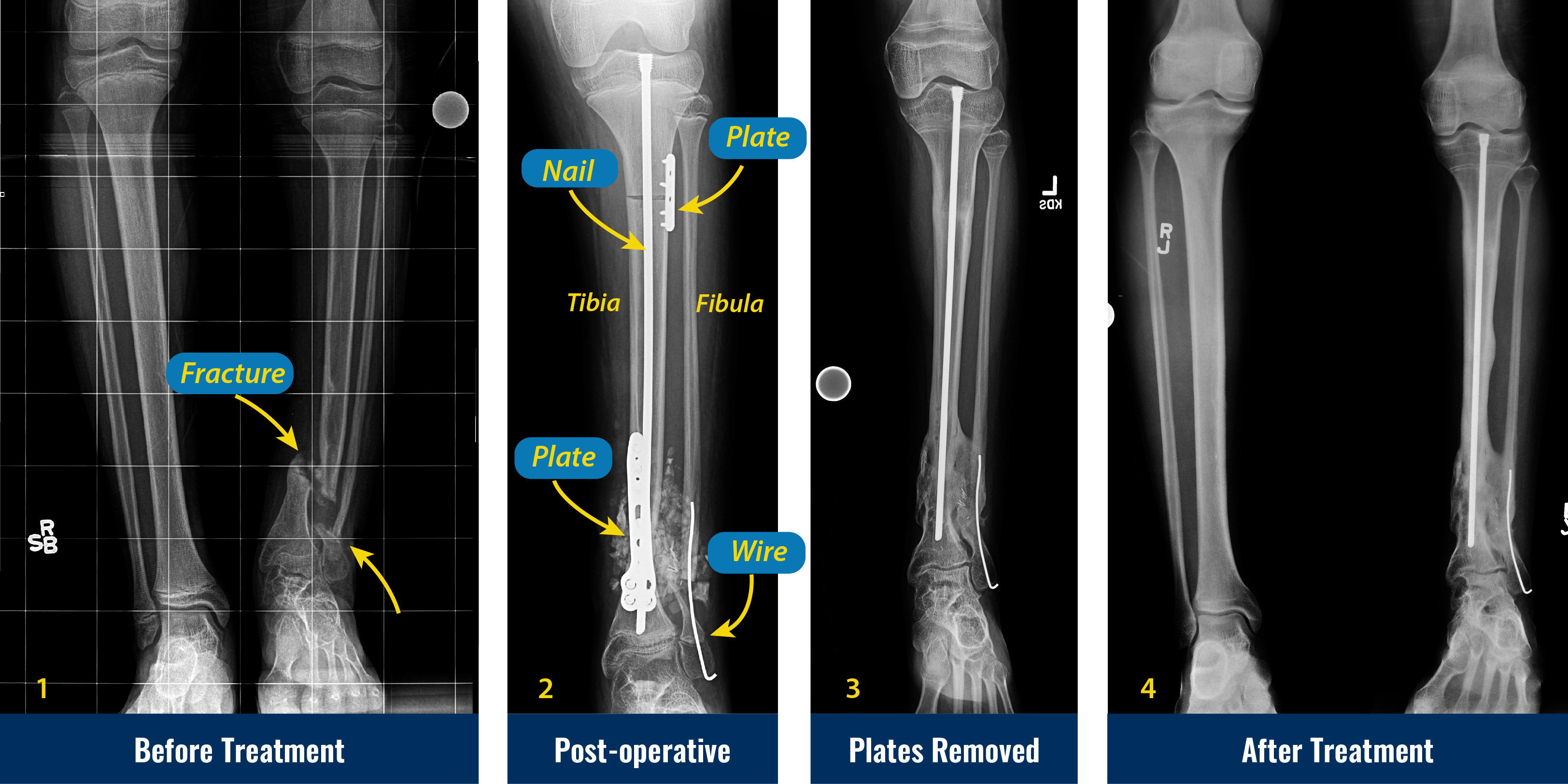 X-rays of congenital pseudarthrosis of the tibia before cross-union treatment, after surgery, after plate removal, and after treatment