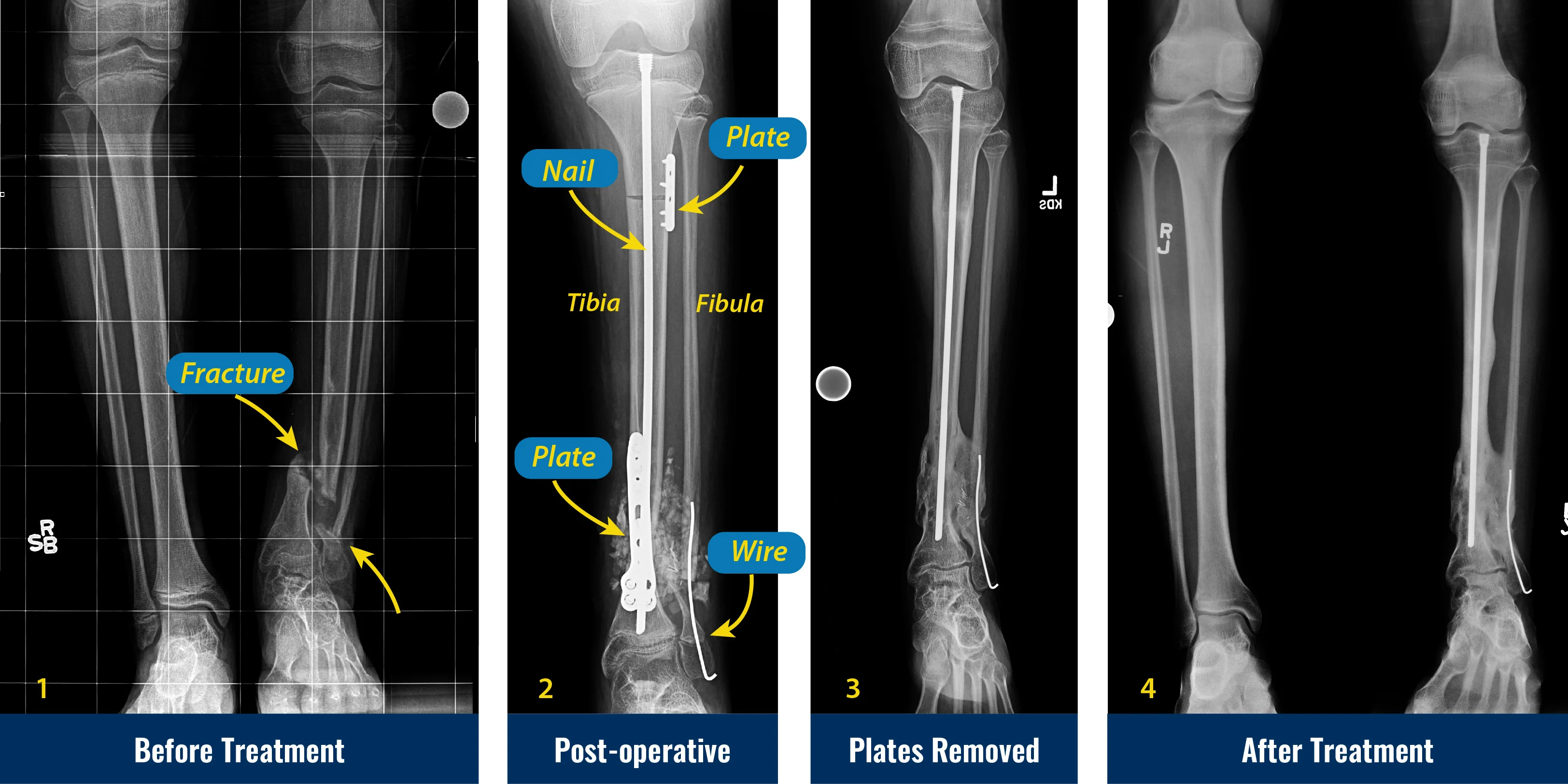 A pilot randomised prospective comparison of two approaches for tibial  nailing using clinical and novel imaging outcome measures – study protocol  | medRxiv