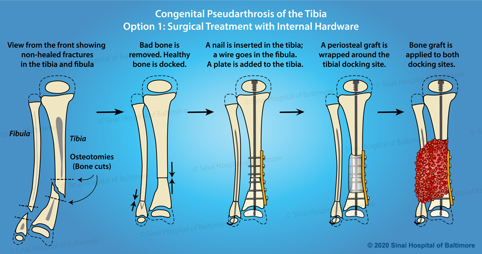 Color illustrations depicting surgical treatment of congenital pseudarthrosis of the tibia with internal hardware, periosteal graft, bone graft, plate and nail: View from the front showing non-healed fractures. Bad bone is removed. Healthy bone is docked. A nail is inserted in the tibia; a wire goes in the fibula. A plate is added to the tibia. A periosteal graft is wrapped around the tibial docking site. Bone graft is applied to both docking sites.