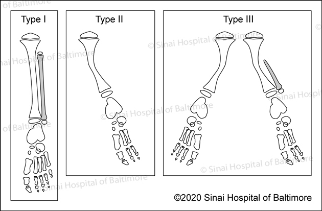 Coventry and Johnson Classification of Fibular Hemimelia: Type I Type II and Type III