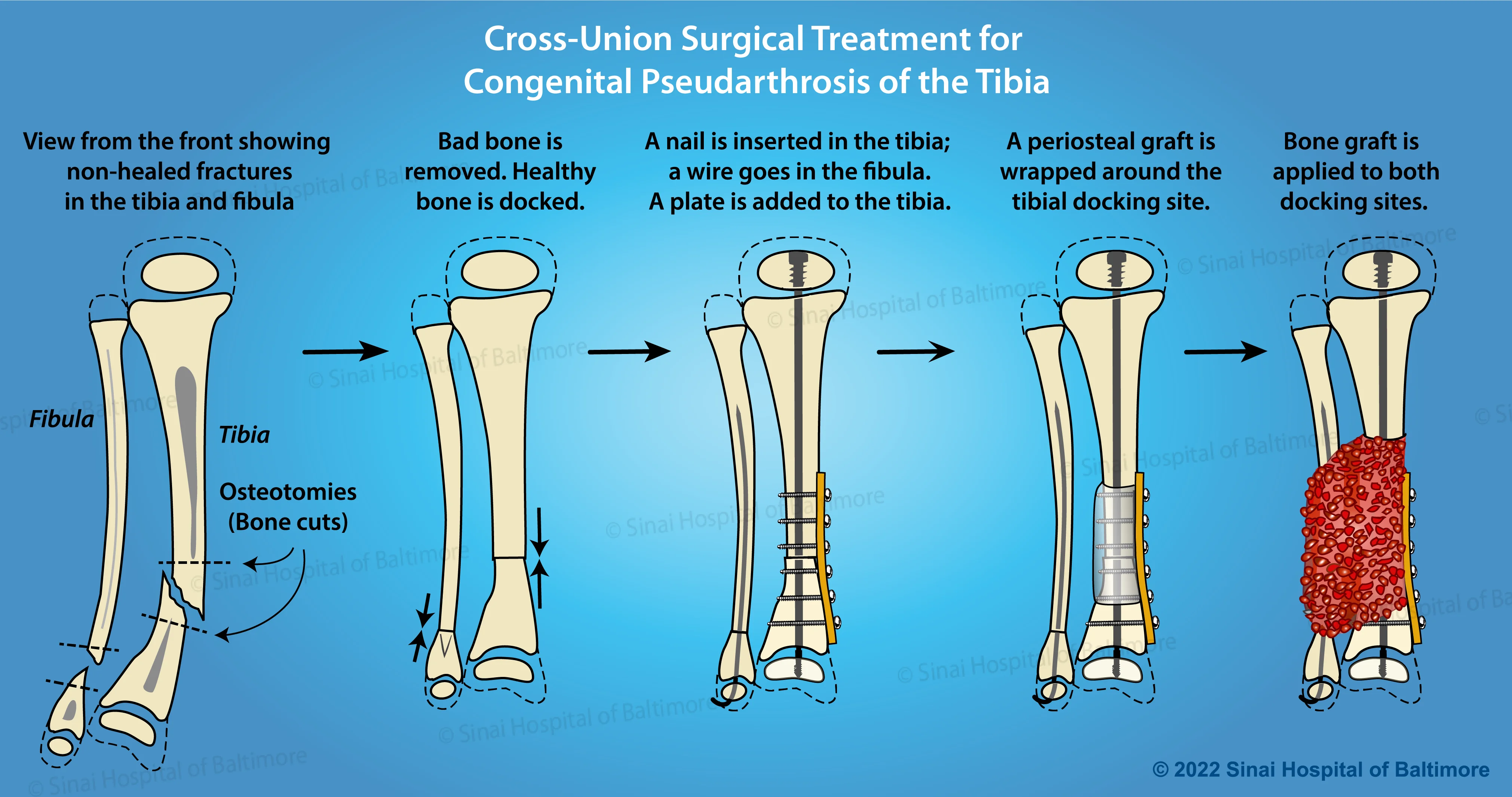 Color illustrations depicting cross-union surgical treatment of congenital pseudarthrosis of the tibia with internal hardware, periosteal graft, bone graft, plate and nail: View from the front showing non-healed fractures. Bad bone is removed. Healthy bone is docked. A nail is inserted in the tibia; a wire goes in the fibula. A plate is added to the tibia. A periosteal graft is wrapped around the tibial docking site. Bone graft is applied to both docking sites.