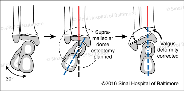 Bony Realignment of Valgus Ankle for Paley Type 2 Fibular Hemimelia: With a 30 degree valgus deformity a supramalleolar dome osteotomy is planned. After completing the dome osteotomy the valgus deformity is corrected and the ankle and foot are aligned.