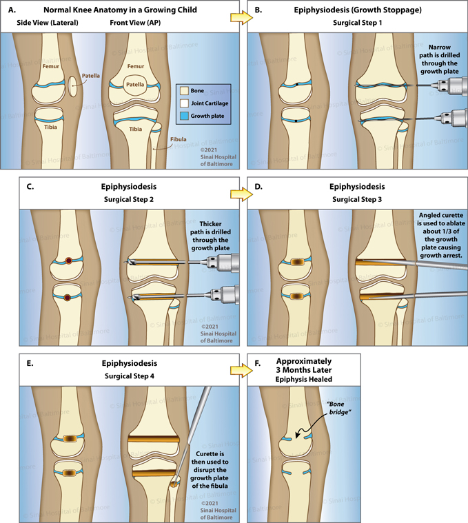 Illustration of a patient's knees showing the steps of growth plate fusion surgery.