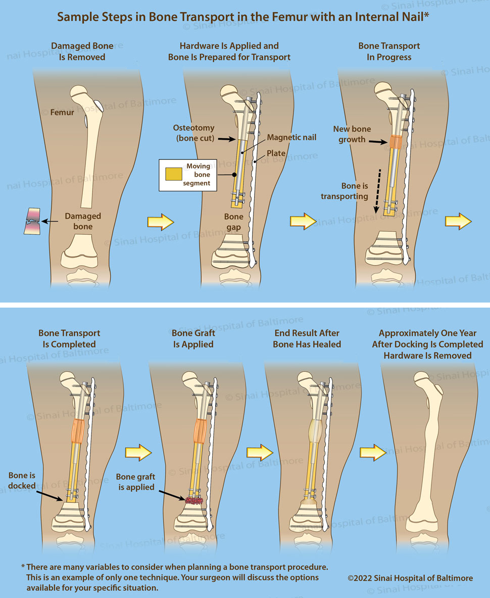 Femur Bone Transport