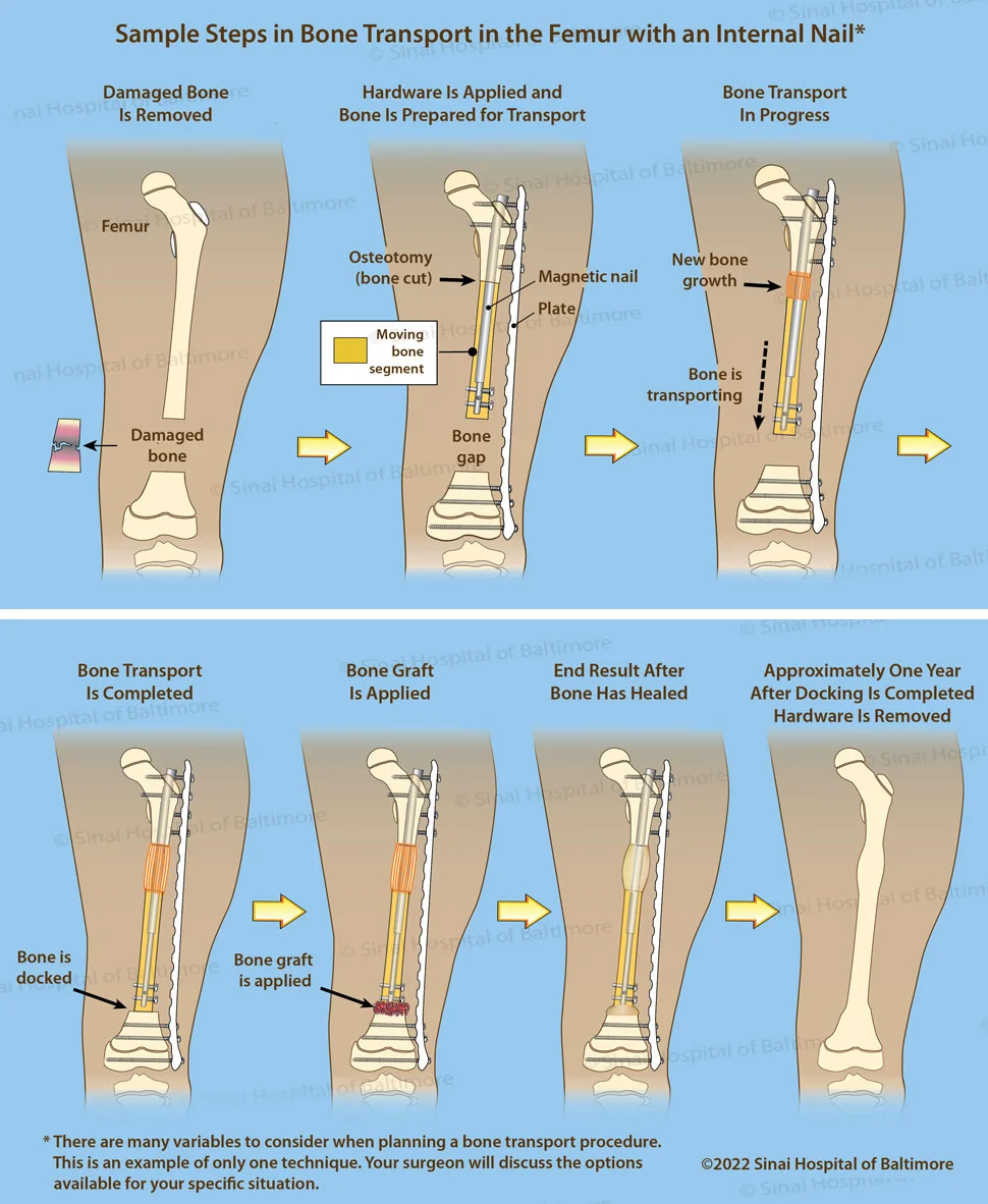 This illustration shows seven images of the various steps and completion of bone transport in the femur using an internal nail.