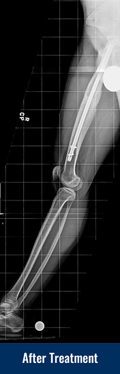X-ray of a 23-year-old male with a fracture malunion of the femur (thigh bone) after acute correction with an internal lengthening nail.