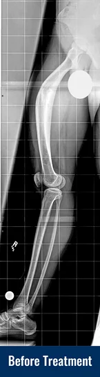 X-ray of a 23-year-old male with a fracture malunion of the femur (thigh bone) before acute correction with an internal lengthening nail.