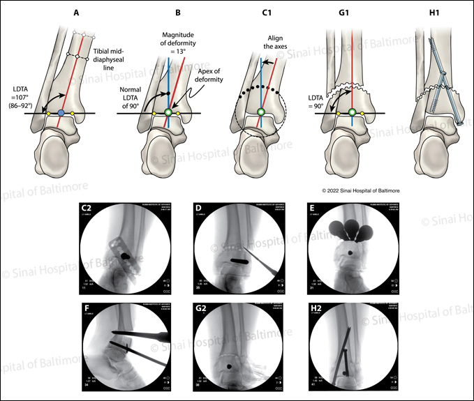 Illustrations and X-rays of a focal dome osteotomy technique for a supramalleolar ankle.