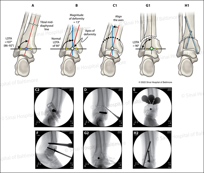 Multiple Drill Hole Osteotomy International Center For Limb Lengthening