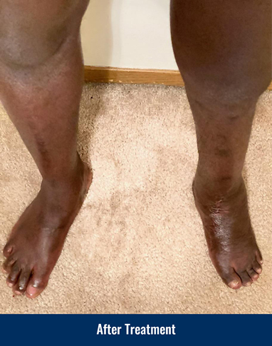 A patient's legs after treatment for a foot and ankle deformity on his left leg