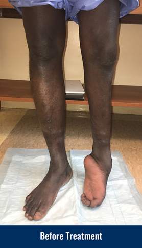 A patient's legs, showing his left leg that has a foot and ankle deformity