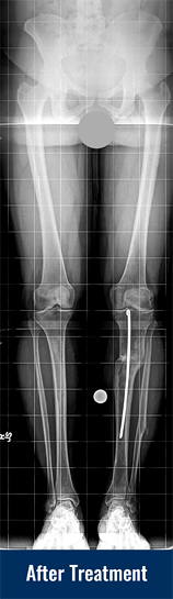 An X-ray of Georgina's legs after treatment for post-traumatic genu valgum of the left tibia, showing her leg is now straightened
