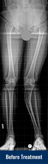 An X-ray of Georgina's legs showing post-traumatic genu valgum of the left tibia