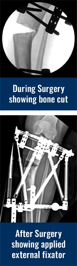 X-rays showing Georgina's left tibia has been cut in order for an external fixator to be applied to make the correction for her knock knee