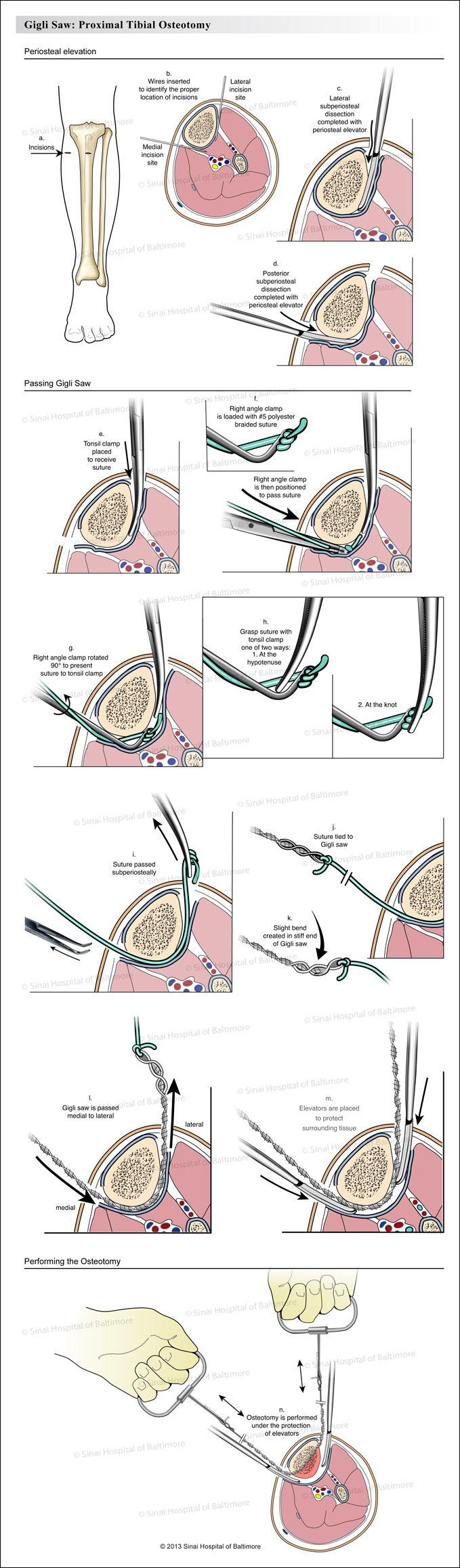 The illustrations describe the surgical procedure of using a gigli saw to perform an osteotomy (bone cut) in the upper end of the tibia (shin bone).